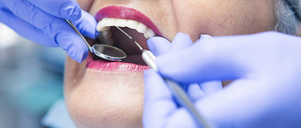 Best Knocked-Out Tooth (Avulsed Tooth) Treatment in East Lake, FL