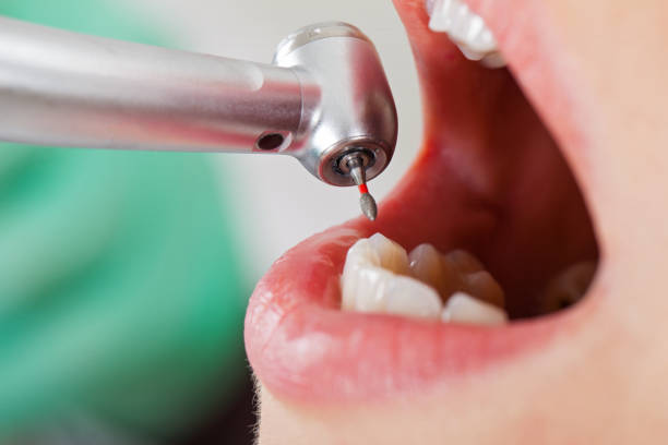Best Lost Filling or Crown Replacement in East Lake, FL